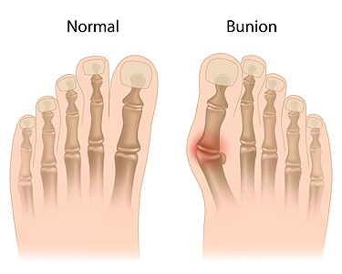 What to Know About Bunion Surgery and Recovery