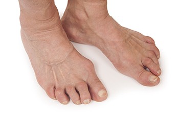 Symptoms and Causes of Rheumatoid Arthritis in the Feet