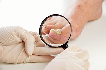 Understanding Fungal Nails