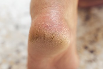 Exploring the Causes of Cracked Heels